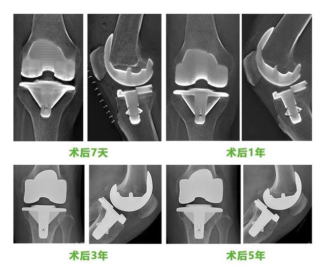 重磅！国家创新医疗器械上市JUST生物膝打破中美技术代差(图6)