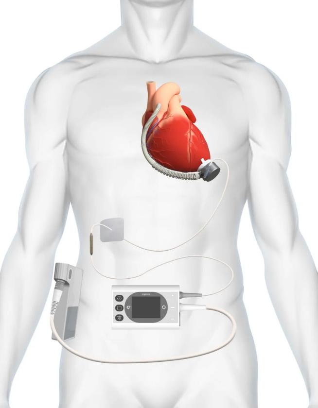 INNOVATE临床试验持续提速同心医疗成功完成第100例BrioVAD系统植入(图2)